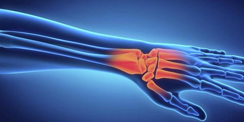 Repetitive Strain Injury Image